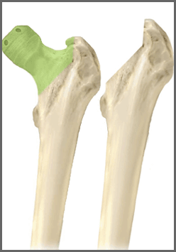 Bone Conservation » Mendelson Kornblum Orthopedic & Spine Specialists