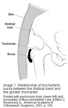 Trochanteric Hip Bursitis  Spine & Orthopedic Center